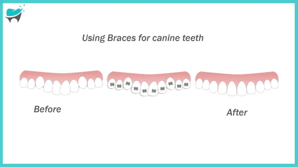 Using Braces for canine teeth infographic