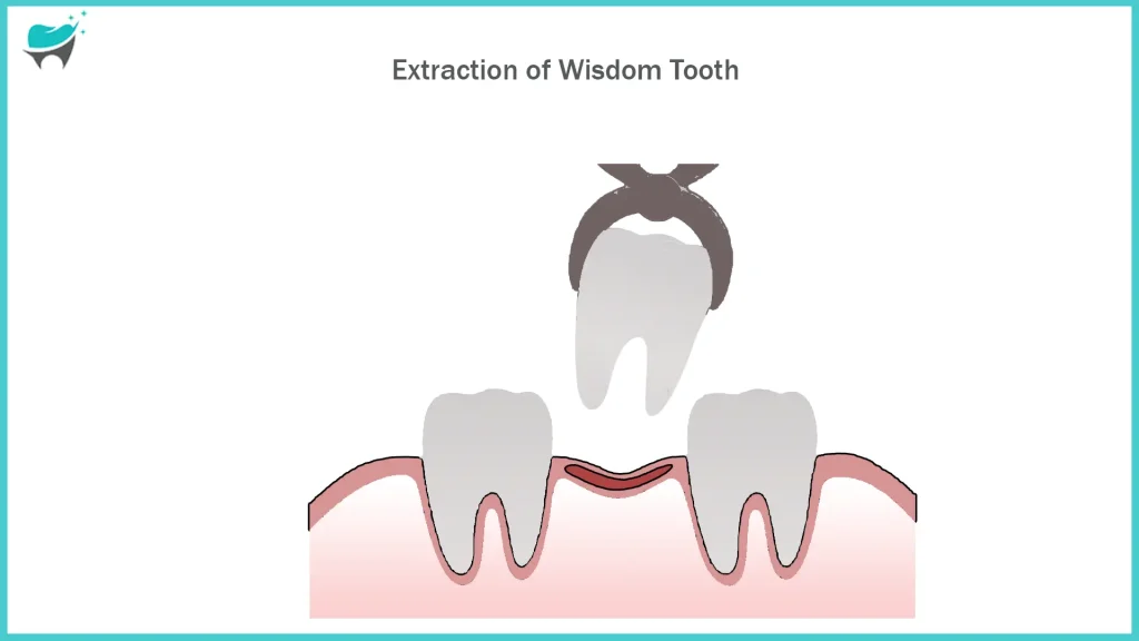 extraction of third molar