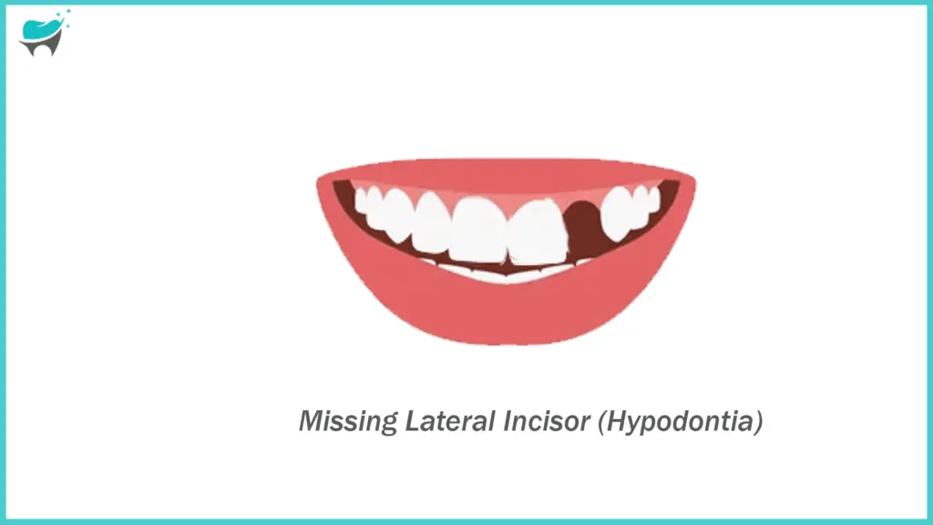 tooth hypodentia 