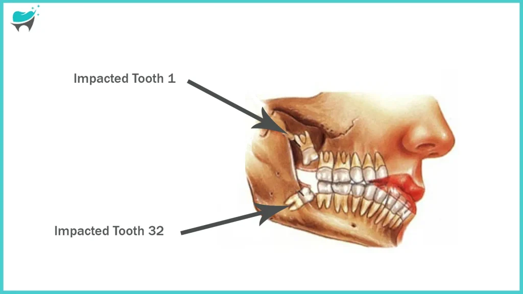 impacted teeth 32
