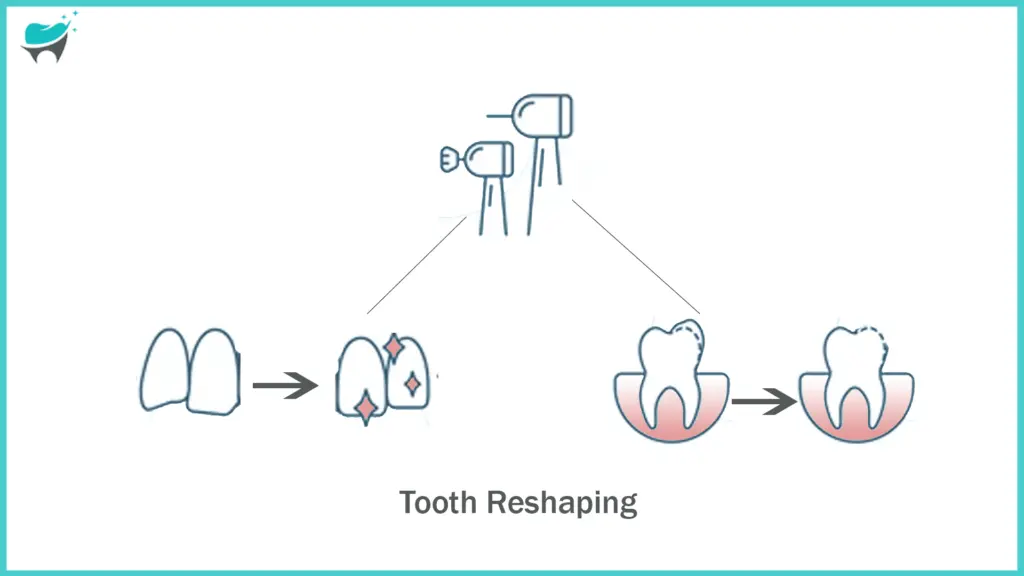reshaping of teeth