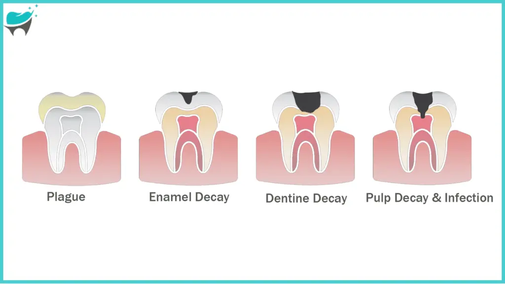 Types of tooth decay canine infographic