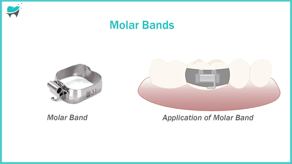 molar bands