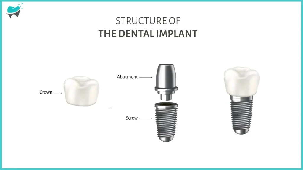 tooth dental implant structure 2
