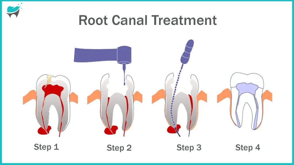 root canal for teeth 15