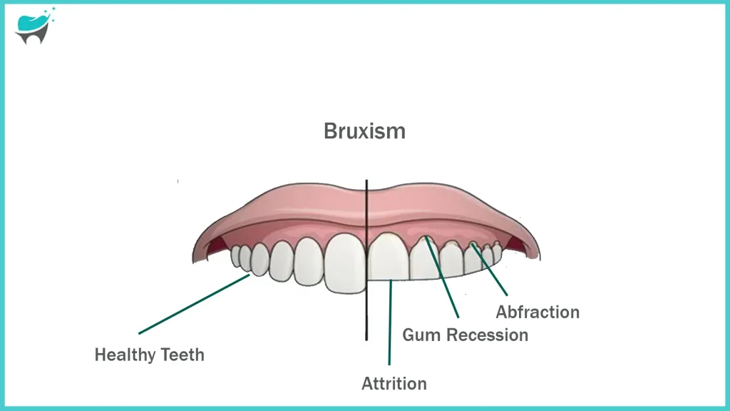 effects of bruxism