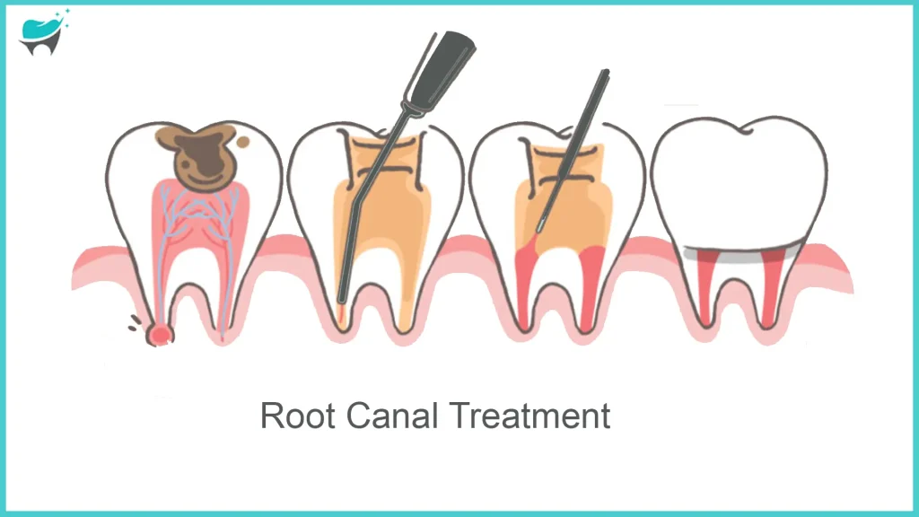 tooth 13 root canal