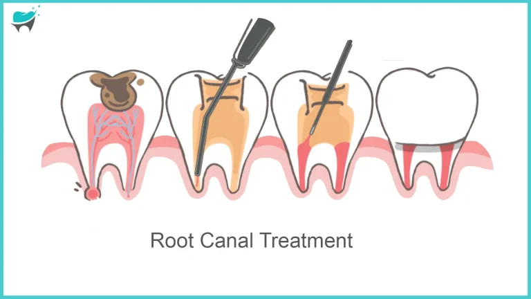 Tooth 13 Chronicles: From Decay to Renewal – and Root Canal Treatment