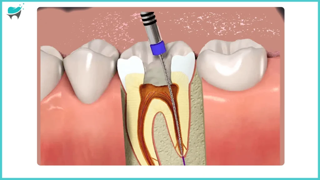 root canal therapy for tooth number 19