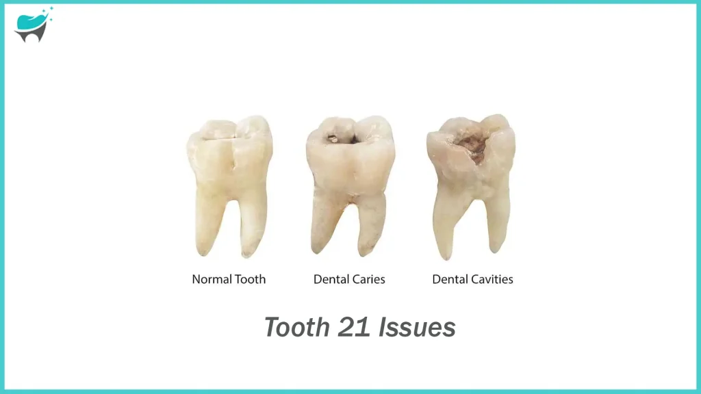 cavities in premolars